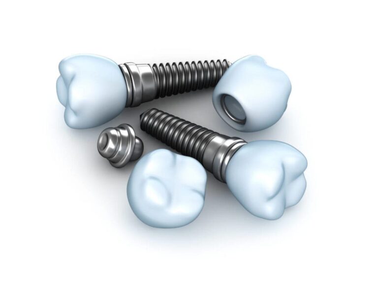 what are dental implants