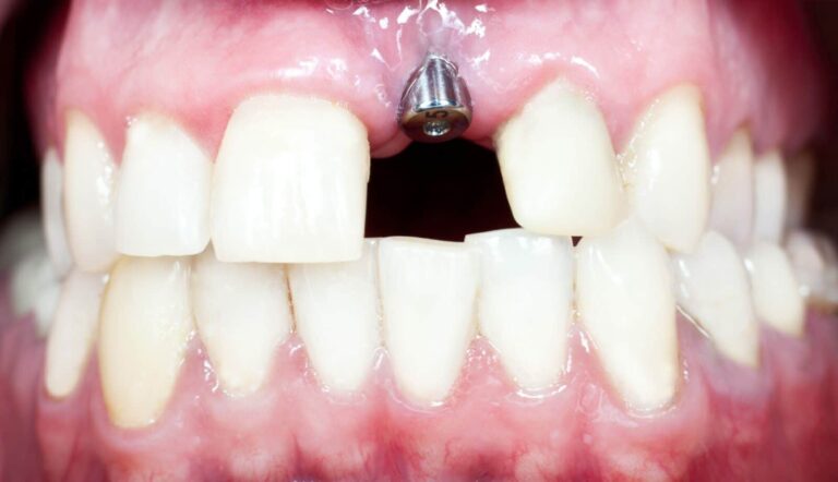 How Long Do Dental Implants Last