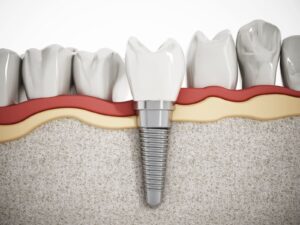 How Long Does It Take To Get Dental Implants