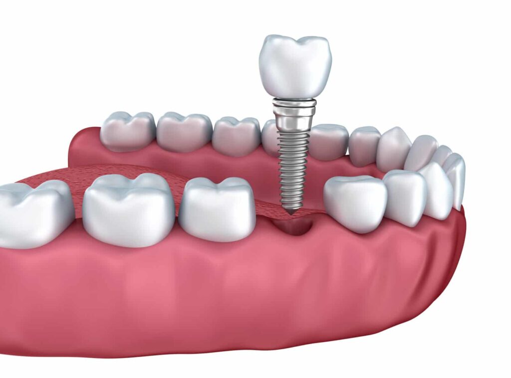 single tooth implant