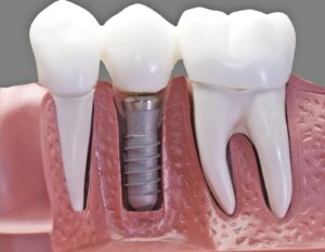 The Cost Of Dental Implants In Arizona